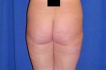Liposuction After Photo by Bahram Ghaderi, MD, FACS; St. Charles, IL - Case 21730