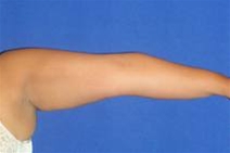 Liposuction After Photo by Bahram Ghaderi, MD, FACS; St. Charles, IL - Case 21731
