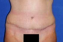 Tummy Tuck After Photo by Bahram Ghaderi, MD, FACS; St. Charles, IL - Case 21733