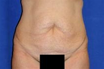 Tummy Tuck Before Photo by Bahram Ghaderi, MD, FACS; St. Charles, IL - Case 21733