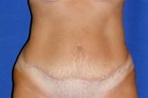 Tummy Tuck After Photo by Bahram Ghaderi, MD, FACS; St. Charles, IL - Case 21734