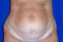 Tummy Tuck Before Photo by Bahram Ghaderi, MD, FACS; St. Charles, IL - Case 21734