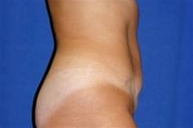 Tummy Tuck After Photo by Bahram Ghaderi, MD, FACS; St. Charles, IL - Case 21734