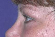 Eyelid Surgery After Photo by Bahram Ghaderi, MD, FACS; St. Charles, IL - Case 6978