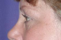 Eyelid Surgery Before Photo by Bahram Ghaderi, MD, FACS; St. Charles, IL - Case 6978