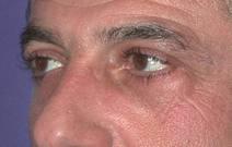 Eyelid Surgery After Photo by Bahram Ghaderi, MD, FACS; St. Charles, IL - Case 6979