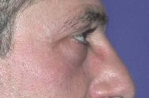 Eyelid Surgery After Photo by Bahram Ghaderi, MD, FACS; St. Charles, IL - Case 6979
