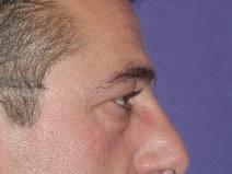 Eyelid Surgery Before Photo by Bahram Ghaderi, MD, FACS; St. Charles, IL - Case 6979