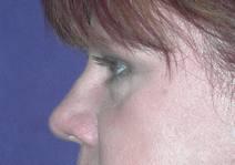 Eyelid Surgery After Photo by Bahram Ghaderi, MD, FACS; St. Charles, IL - Case 6980