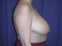 Breast Reduction Before Photo by Bahram Ghaderi, MD, FACS; St. Charles, IL - Case 6981