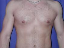 Liposuction After Photo by Bahram Ghaderi, MD, FACS; St. Charles, IL - Case 6984