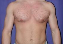 Liposuction Before Photo by Bahram Ghaderi, MD, FACS; St. Charles, IL - Case 6984