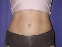 Liposuction After Photo by Bahram Ghaderi, MD, FACS; St. Charles, IL - Case 6985