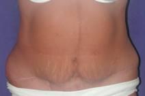 Body Contouring After Photo by Bahram Ghaderi, MD, FACS; St. Charles, IL - Case 6986