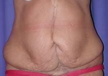 Body Contouring Before Photo by Bahram Ghaderi, MD, FACS; St. Charles, IL - Case 6986