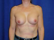 Breast Augmentation After Photo by Bahram Ghaderi, MD, FACS; ,  - Case 7521