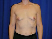 Breast Augmentation Before Photo by Bahram Ghaderi, MD, FACS; ,  - Case 7521