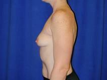 Breast Augmentation Before Photo by Bahram Ghaderi, MD, FACS; ,  - Case 7521