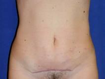 Tummy Tuck After Photo by Bahram Ghaderi, MD, FACS; St. Charles, IL - Case 9370