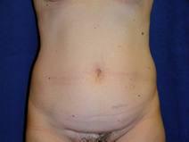 Tummy Tuck Before Photo by Bahram Ghaderi, MD, FACS; St. Charles, IL - Case 9370