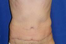 Tummy Tuck After Photo by Bahram Ghaderi, MD, FACS; St. Charles, IL - Case 9371