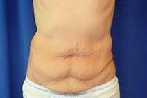 Tummy Tuck Before Photo by Bahram Ghaderi, MD, FACS; St. Charles, IL - Case 9371
