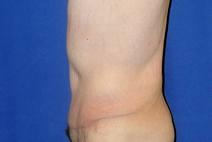 Tummy Tuck After Photo by Bahram Ghaderi, MD, FACS; St. Charles, IL - Case 9371
