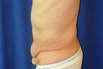 Tummy Tuck Before Photo by Bahram Ghaderi, MD, FACS; St. Charles, IL - Case 9371