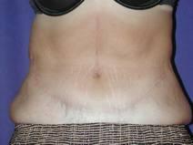 Tummy Tuck After Photo by Bahram Ghaderi, MD, FACS; St. Charles, IL - Case 9372