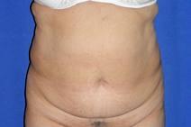 Tummy Tuck Before Photo by Bahram Ghaderi, MD, FACS; St. Charles, IL - Case 9373