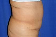 Tummy Tuck After Photo by Bahram Ghaderi, MD, FACS; St. Charles, IL - Case 9373