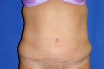 Tummy Tuck After Photo by Bahram Ghaderi, MD, FACS; St. Charles, IL - Case 9374