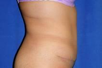 Tummy Tuck After Photo by Bahram Ghaderi, MD, FACS; St. Charles, IL - Case 9374
