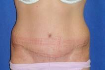 Tummy Tuck After Photo by Bahram Ghaderi, MD, FACS; St. Charles, IL - Case 9375