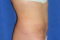 Tummy Tuck After Photo by Bahram Ghaderi, MD, FACS; St. Charles, IL - Case 9375