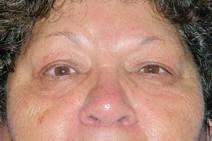 Eyelid Surgery After Photo by Bahram Ghaderi, MD, FACS; ,  - Case 9382