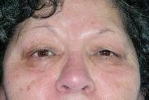 Eyelid Surgery Before Photo by Bahram Ghaderi, MD, FACS; ,  - Case 9382