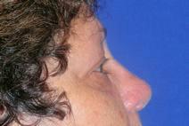 Eyelid Surgery After Photo by Bahram Ghaderi, MD, FACS; ,  - Case 9382