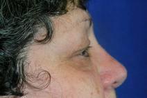 Eyelid Surgery Before Photo by Bahram Ghaderi, MD, FACS; ,  - Case 9382