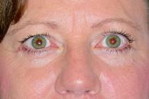 Eyelid Surgery After Photo by Bahram Ghaderi, MD, FACS; St. Charles, IL - Case 9384