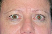 Eyelid Surgery Before Photo by Bahram Ghaderi, MD, FACS; St. Charles, IL - Case 9384