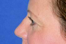 Eyelid Surgery After Photo by Bahram Ghaderi, MD, FACS; St. Charles, IL - Case 9384