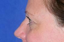 Eyelid Surgery Before Photo by Bahram Ghaderi, MD, FACS; St. Charles, IL - Case 9384