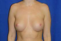 Breast Augmentation After Photo by Bahram Ghaderi, MD, FACS; St. Charles, IL - Case 9387