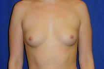 Breast Augmentation Before Photo by Bahram Ghaderi, MD, FACS; St. Charles, IL - Case 9387