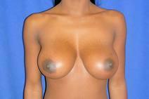 Breast Augmentation After Photo by Bahram Ghaderi, MD, FACS; St. Charles, IL - Case 9389