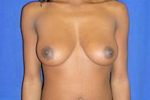 Breast Augmentation Before Photo by Bahram Ghaderi, MD, FACS; St. Charles, IL - Case 9389