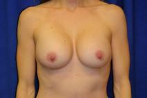 Breast Augmentation After Photo by Bahram Ghaderi, MD, FACS; St. Charles, IL - Case 9390
