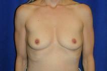 Breast Augmentation Before Photo by Bahram Ghaderi, MD, FACS; St. Charles, IL - Case 9390