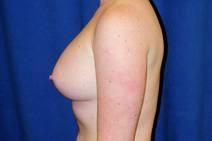Breast Augmentation After Photo by Bahram Ghaderi, MD, FACS; St. Charles, IL - Case 9391